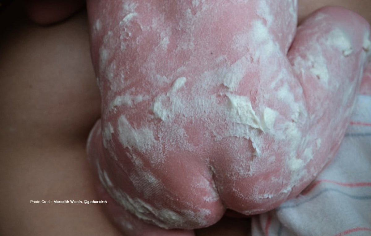 What Is Vernix Caseosa?